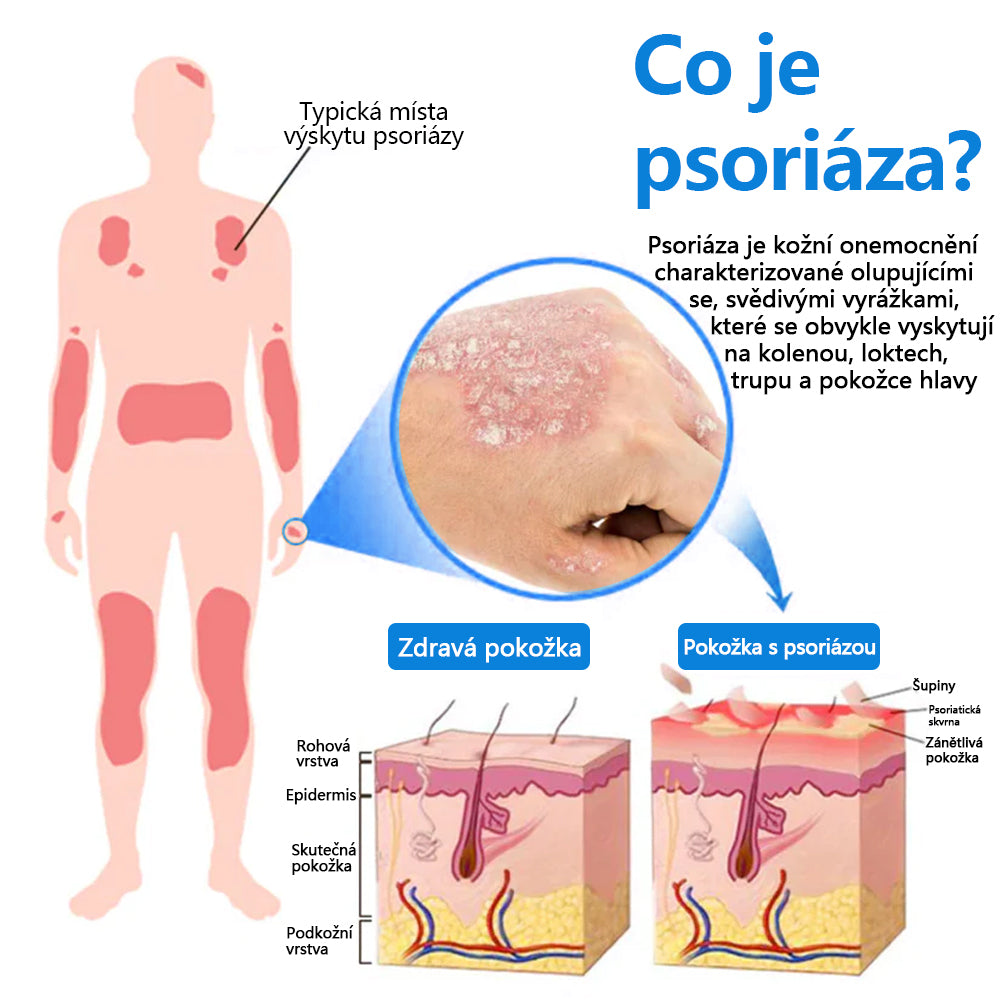 【Oficiální značkový obchod】✅Zvoevo® Magnesium bylinný sprej ⚕️ Certifikace MHRA – úleva při psoriáze, ekzému, intimních bakteriálních infekcích, akné a tmavých skvrnách