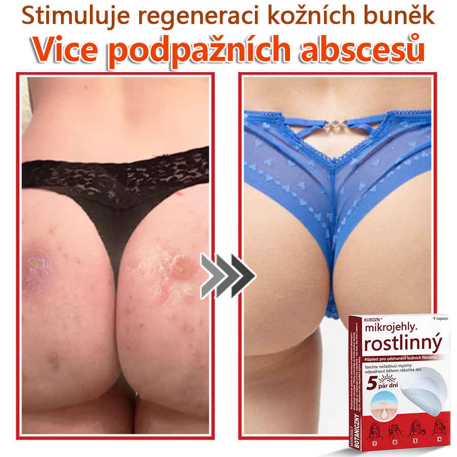 🔥🔥🔥KUBOZN® Mikroneedle Botanické náplasti na odstranění kožních výrůstků | Vyrobeno v České republice