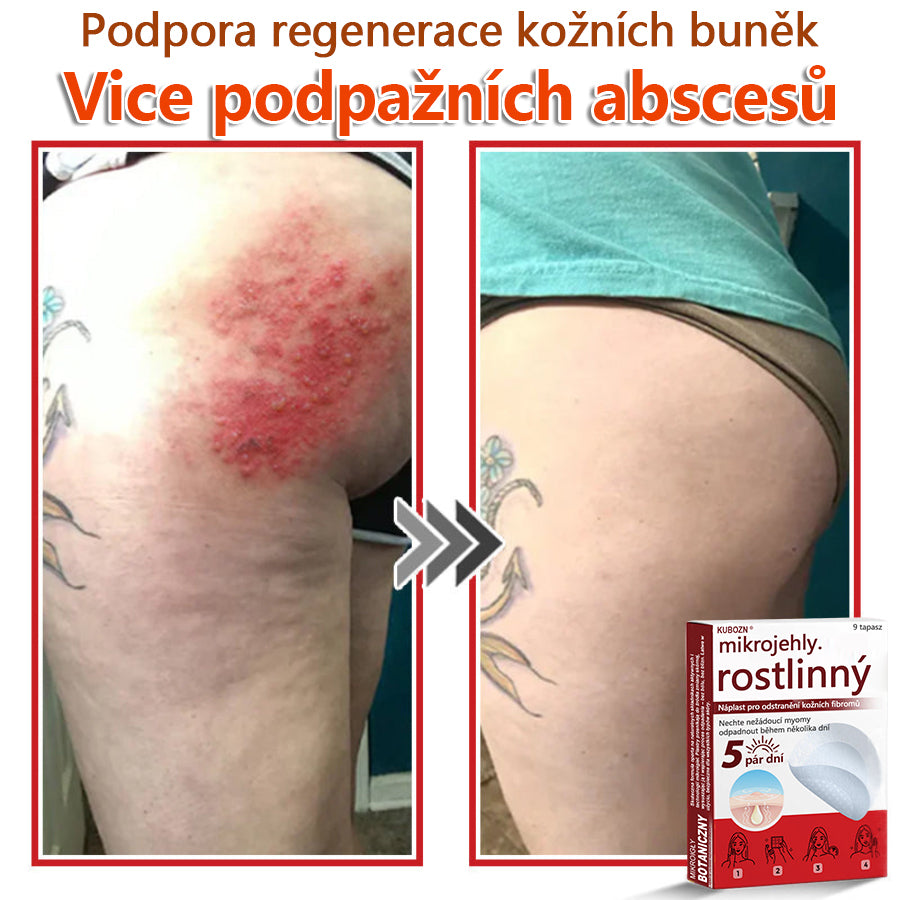 🔥🔥🔥KUBOZN® Mikroneedle Botanické náplasti na odstranění kožních výrůstků | Vyrobeno v České republice