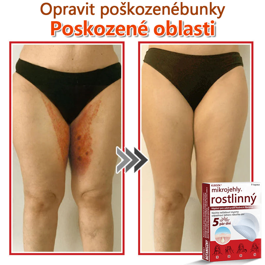 🔥🔥🔥KUBOZN® Mikroneedle Botanické náplasti na odstranění kožních výrůstků | Vyrobeno v České republice