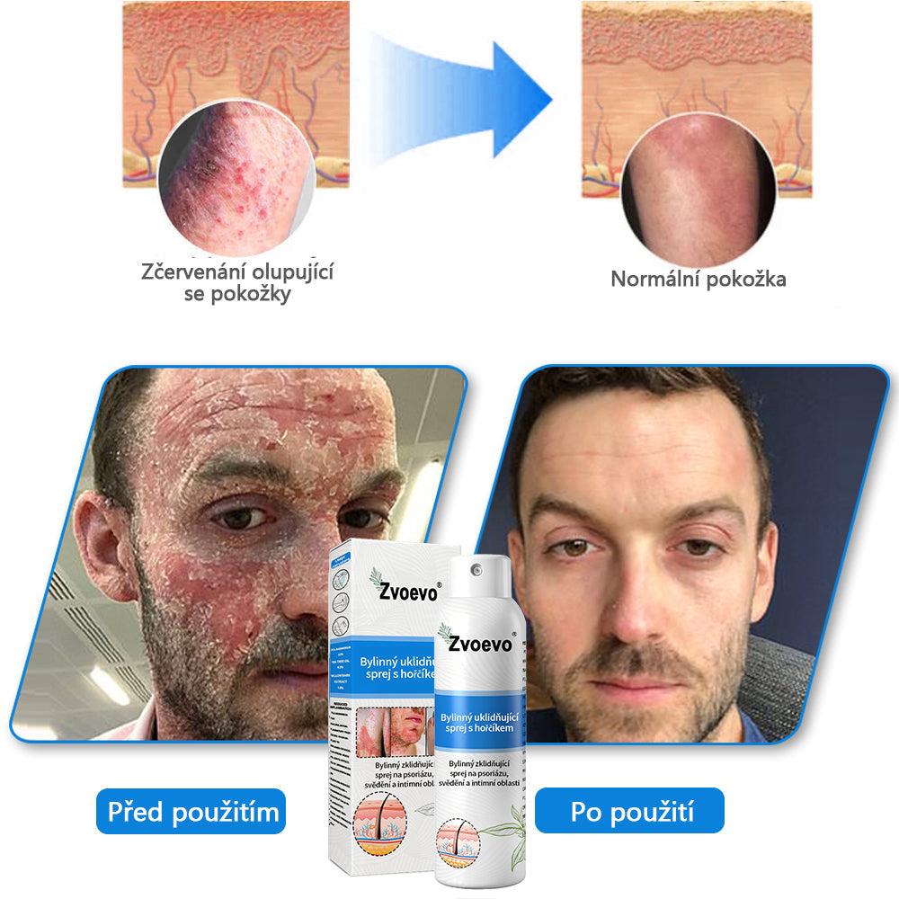 【Oficiální značkový obchod】✅Zvoevo® Magnesium bylinný sprej ⚕️ Certifikace MHRA – úleva při psoriáze, ekzému, intimních bakteriálních infekcích, akné a tmavých skvrnách