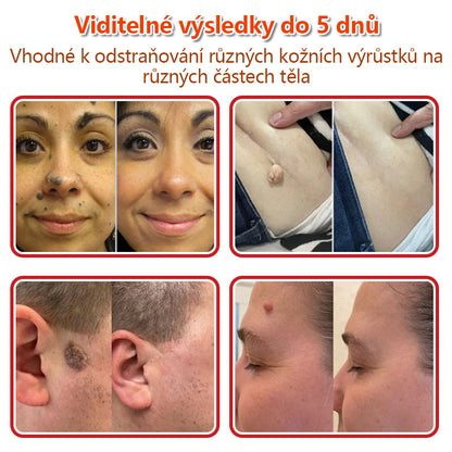 🔥🔥🔥KUBOZN® Mikroneedle Botanické náplasti na odstranění kožních výrůstků | Vyrobeno v České republice