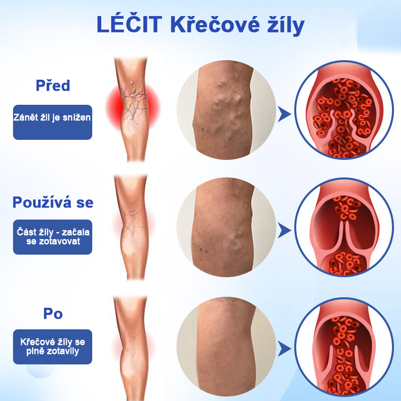 🌱🌠✨Sprej na léčbu křečových žil Veinhealing™🌿🌿