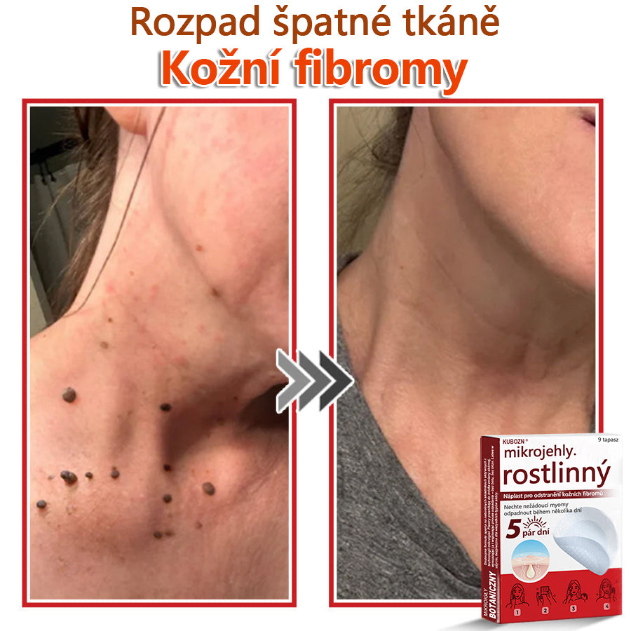 🔥🔥🔥KUBOZN® Mikroneedle Botanické náplasti na odstranění kožních výrůstků | Vyrobeno v České republice