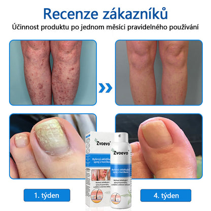 【Oficiální značkový obchod】✅Zvoevo® Magnesium bylinný sprej ⚕️ Certifikace MHRA – úleva při psoriáze, ekzému, intimních bakteriálních infekcích, akné a tmavých skvrnách