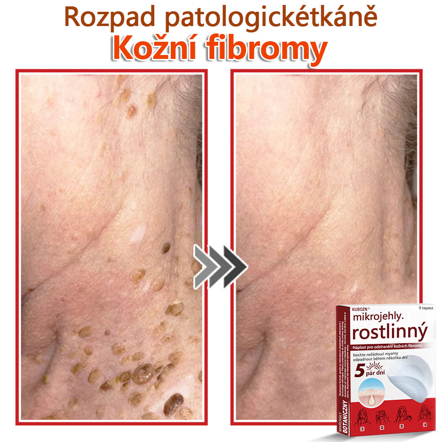 🔥🔥🔥KUBOZN® Mikroneedle Botanické náplasti na odstranění kožních výrůstků | Vyrobeno v České republice