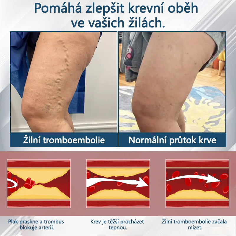 💧💧💧ATTDX® Bylinný krém na zmírnění otoků s černou natí